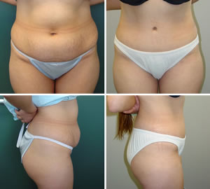 Tummy Tuck Before & After Photos