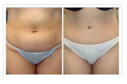 Tummy Tuck Before & After Photos