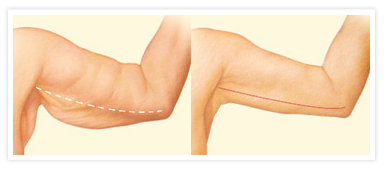 Arm Lift