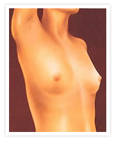 Breast Augmentation Photos