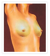 Breast Augmentation Photos