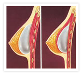 Breast Augmentation Photos