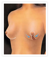 Blepharoplasty Images
