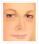 Blepharoplasty Images