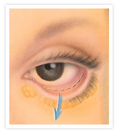 Blepharoplasty Images