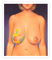 Breast Reduction Photos