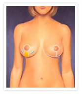 Breast Reduction Photos