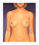 Breast Reduction Photos