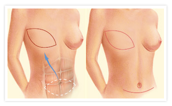 Breast Reconstruction