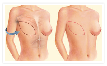 Breast Reconstruction