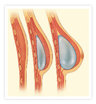 Breast Reconstruction