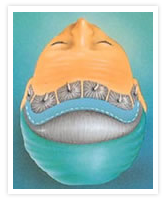 Browlift Image
