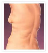 Tummy Tuck Photos