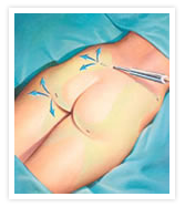 Tummy Tuck Photos