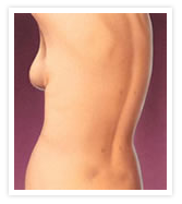 Tummy Tuck Photos