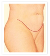 Tummy Tuck Illustration