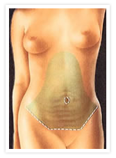 Tummy Tuck Photos