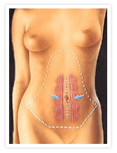 Tummy Tuck Photos